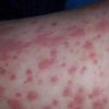 过敏性紫癜病怎么治疗