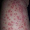 解析过敏性紫癜治疗的手法