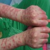 红斑狼疮的发病因素