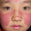 红斑狼疮的初期表现有哪些