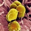 淋病奈瑟菌引起什么症状
