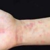 淋病奈瑟菌感染症状