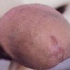 淋病急性皮损的症状
