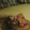 淋病患者在治疗中有哪些要注意的