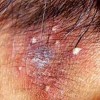 不同部位毛囊炎的护理注意什么