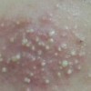 糠秕孢子菌毛囊炎如何注意预防