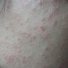 糠秕孢子菌性毛囊炎怎么治疗