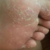 患者该如何治疗手足癣
