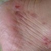 关于手足癣治疗的相关介绍