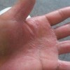 静脉排毒疗法治疗手足癣什么时候都不迟