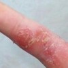 足癣的治疗难吗