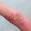 角化型手足癣的治疗