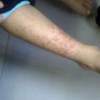 过敏性紫癜患者饮食禁忌