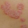 疥疮病人在日常里怎样做好预防护理呢