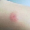 疥疮的发病期症状