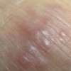 几种不同疥疮的症状