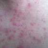盘状狼疮注意护理