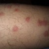 系统性红斑狼疮该怎样护理呢
