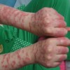 小儿鲜红斑痣怎样护理