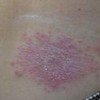 红斑狼疮的致病因素