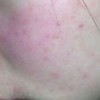 盘状红斑狼疮病因