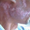 女性患红斑狼疮的病因有什么