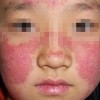 什么才是红斑狼疮的症状呢