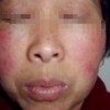 哪些发病表现属于红斑狼疮患者
