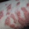 盘状红斑狼疮症状有什么