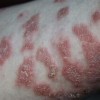 红狼斑疮有哪些表现