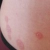 青岛玫瑰糠疹的诊断及治疗的手法