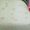 青岛玫瑰糠疹的诊断和治疗