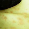 玫瑰糠疹的具体症状有哪些