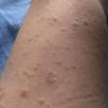 玫瑰糠疹的早期的症状是什么