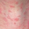 青岛玫瑰糠疹的治疗的手法是什么呢