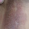 系统性硬皮病患者心理护理