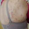 硬皮病护理该怎样做呢