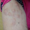 硬皮病临床医学病症表现都有什么呢