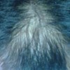 斑秃与脂溢性脱发的症状有什么不同