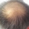 到底吃什么能够治疗脱发呢