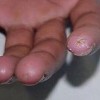 系统性硬斑病的临床症状与表现