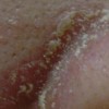 冬季也需要预防日光性皮炎