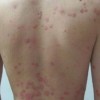 生活中怎样预防过敏性皮炎
