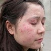 神经性皮炎应怎样治疗呢