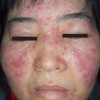 怎么治疗皮炎比较好