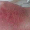 腰部皮炎需要怎治疗
