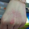 食疗治疗脂溢性皮炎