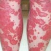 对于牛皮癣患者来说心理治疗、药物治疗同等重要