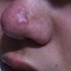 酒糟鼻的预防知识