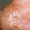 酒糟鼻发生的相关因素是什么